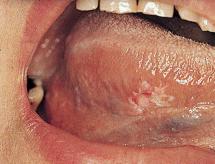 Small Rough Patch On Roof Of Mouth